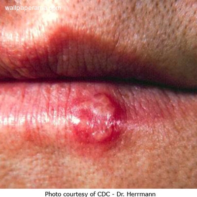 Herpes On Lips. a Pimple or Lip Herpes