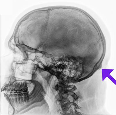 bump brain tumor lumps bumps xray lump tumors